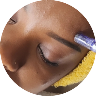 Microneedling + Soin profond : 1H45