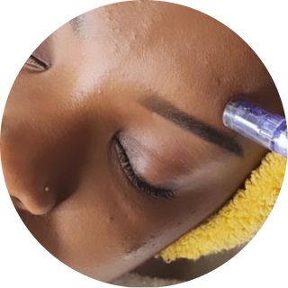 Microneedling + Extraction : 1H00